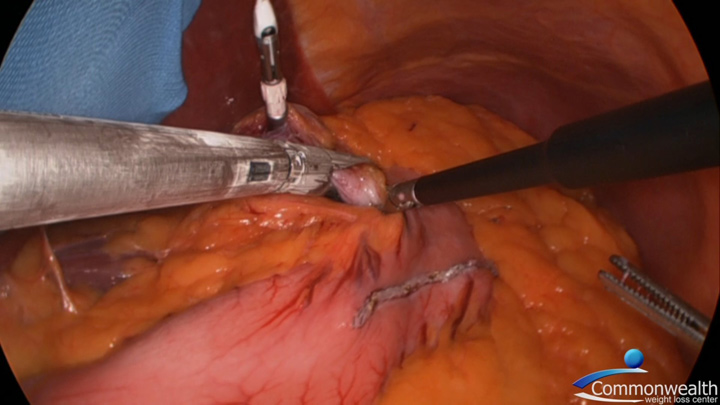 Laparoscopic Roux-en-Y Gastric Bypass