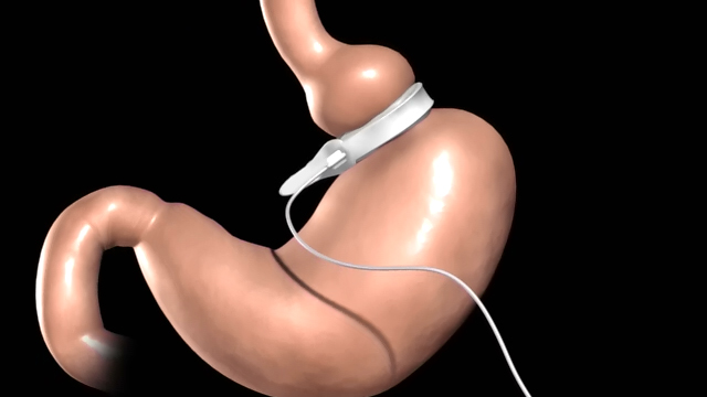 Adjustable Gastric Banding