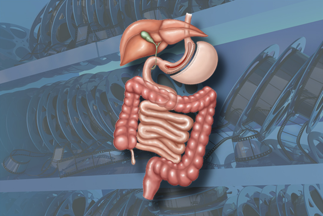 Sleeve gastrectomy